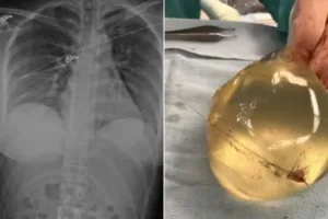 Profile 5 breast implant