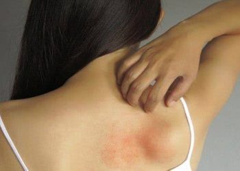 5 Home remedies to get rid of heat rash