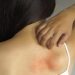 5 Home remedies to get rid of heat rash 10 5 Home remedies to get rid of heat rash