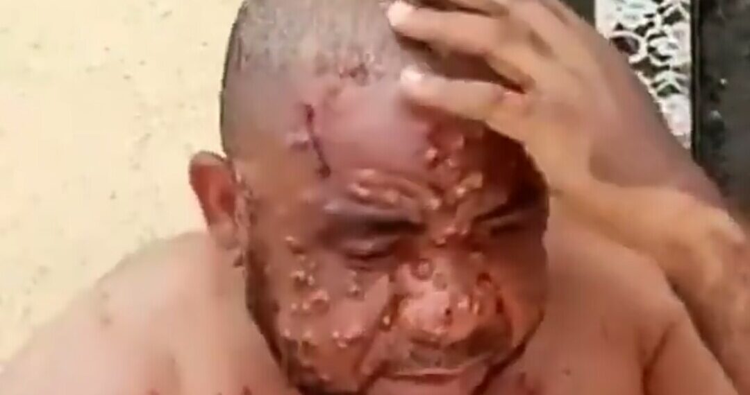Nigerian man suffering from monkeypox reveals how he was misdiagnosed by several doctors over his ailment (VIDEO)