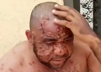 Nigerian man suffering from monkeypox reveals how he was misdiagnosed by several doctors over his ailment (VIDEO)