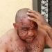 Nigerian man suffering from monkeypox reveals how he was misdiagnosed by several doctors over his ailment (VIDEO)