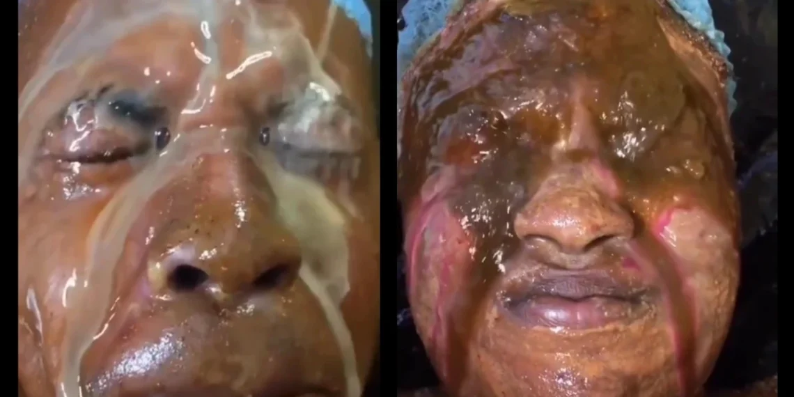 Viral video of a man and woman bleaching their skin in a very shocking procedure