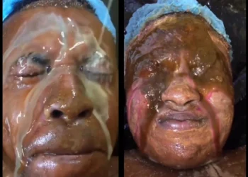 Viral video of a man and woman bleaching their skin in a very shocking procedure