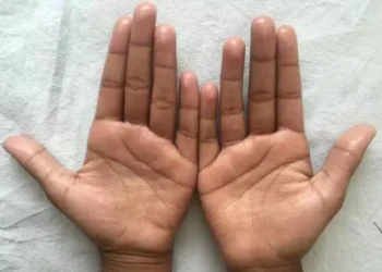 Simple ways to tackle sweaty palms and feet