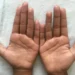 Simple ways to tackle sweaty palms and feet 10 Simple ways to tackle sweaty palms and feet