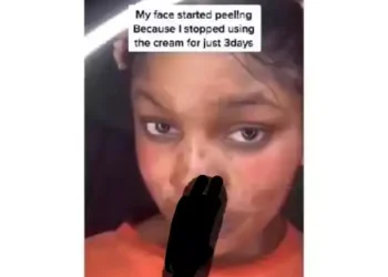 Skin glow goes wrong – young lady shares face transformation after using face glow (video)