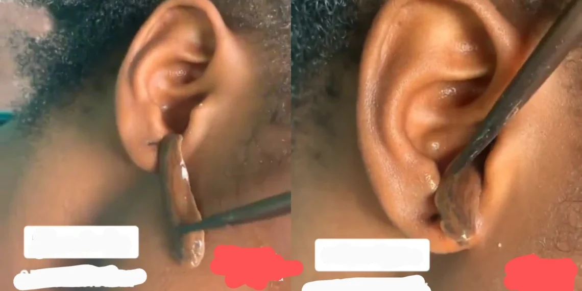 Snake-like Worms Of Different Sizes Pulled Out Of A Lady's Ear (Watch Video) 1 Snake-like Worms Of Different Sizes Pulled Out Of A Lady’s Ear (Watch Video)