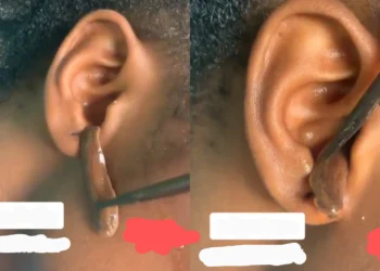 Snake-like Worms Of Different Sizes Pulled Out Of A Lady’s Ear (Watch Video)