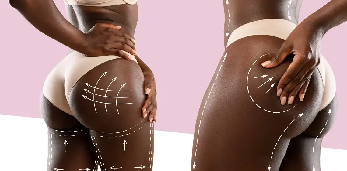 9 Hidden Facts About BBL (Brazilian Butt Lift) You Need to Know 1 9 Hidden Facts About BBL (Brazilian Butt Lift) You Need to Know