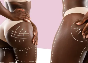 9 Hidden Facts About BBL (Brazilian Butt Lift) You Need to Know