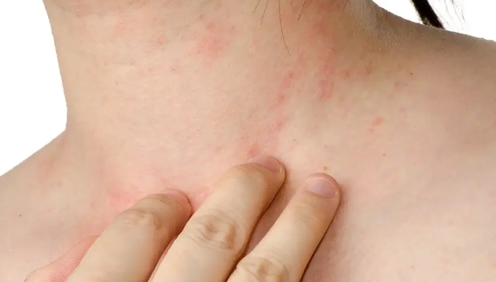 5 Alternatives to Treat Eczema Other Than Taking Drugs