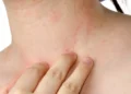 5 Alternatives to Treat Eczema Other Than Taking Drugs 5 5 Alternatives to Treat Eczema Other Than Taking Drugs