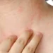 5 Alternatives to Treat Eczema Other Than Taking Drugs 10 5 Alternatives to Treat Eczema Other Than Taking Drugs