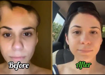 Before and After Video of a brain tumor cancer survivor 6 Before and After Video of a brain tumor cancer survivor