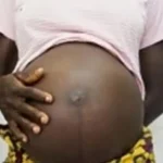 Teenage pregnancy