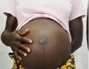 Teenage pregnancy